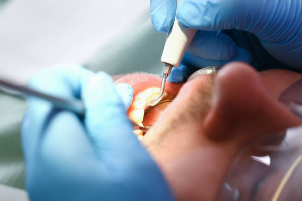 Best Emergency Treatment for Dental Infections or Abscesses in Cleveland, NC